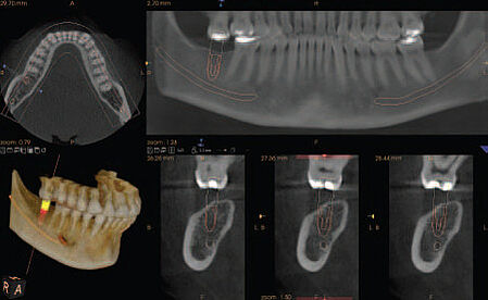 3D - Röntgen / Digitale Volumentomographie (DVT)